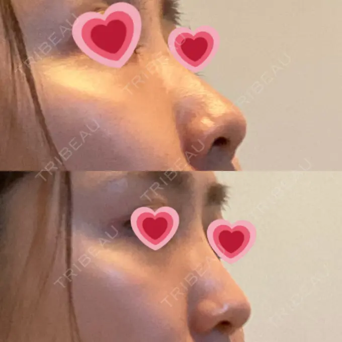 隆鼻術 / 鼻尖形成（切開） / 軟骨移植 / 骨切幅寄せ THE ROPPONGI CLINIC（ザ 六本木クリニック） BEFORE メイン用