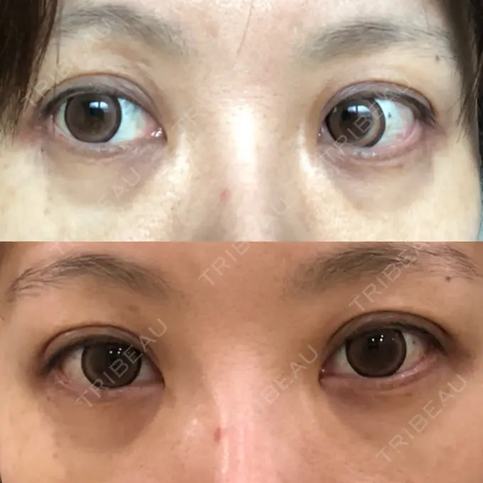 クマ治療 / 下まぶたたるみ取り / 下まぶたの脂肪取り 湘南美容クリニック 橋本院 BEFORE メイン用