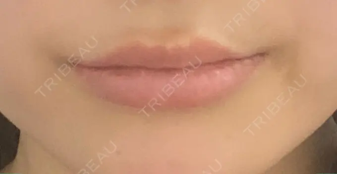 ヒアルロン酸注入（唇） / ボトックス（口角） ルラ美容クリニック 渋谷本院 BEFORE メイン用