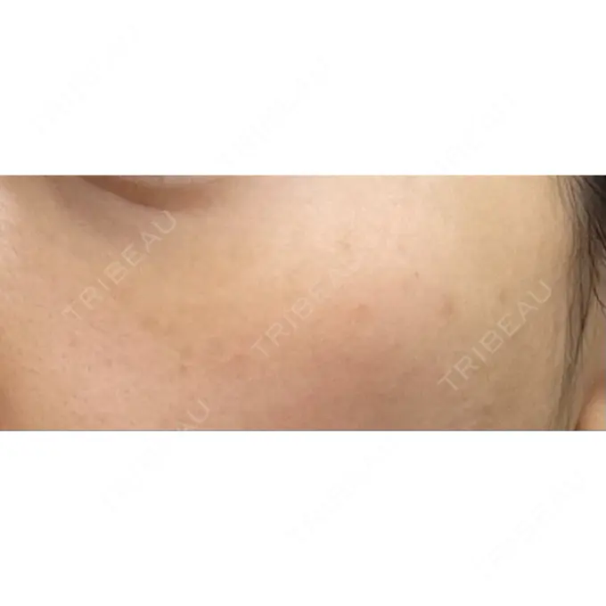 シミ取りレーザー / ピコレーザートーニング（美白・肝斑） PICO BEAUTY CLINIC BEFORE メイン用