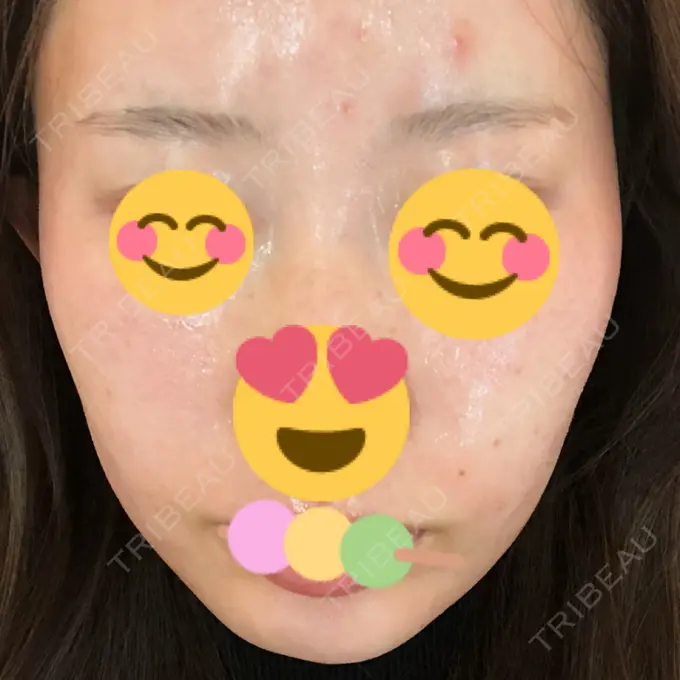 糸リフト / ヒアルロン酸注入（あご） ノーチェビューティクリニック BEFORE メイン用