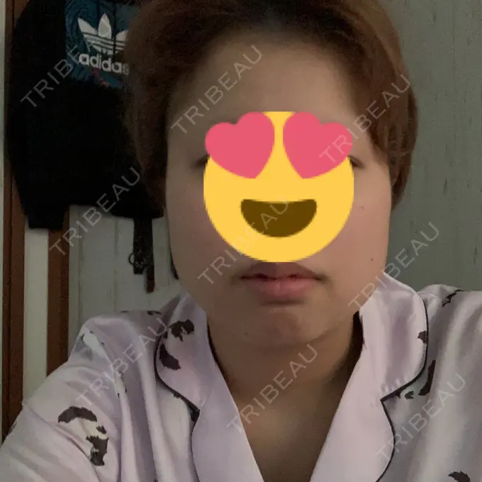 ボトックス（あご） / ボトックス（エラ・小顔） 湘南美容クリニック 名古屋栄院 BEFORE メイン用