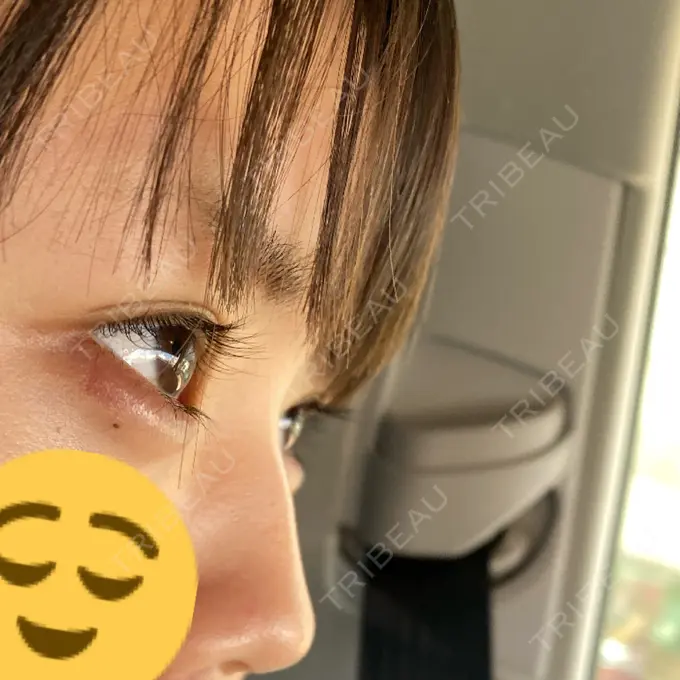 ヒアルロン酸注入（鼻） / ヒアルロン酸注入（あご） 神戸元町ビューティークリニック BEFORE メイン用