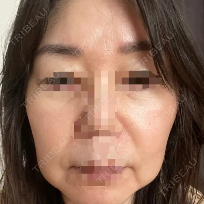 脂肪吸引（顔） / 切開リフト 恵聖会クリニック 京橋院 BEFORE メイン用