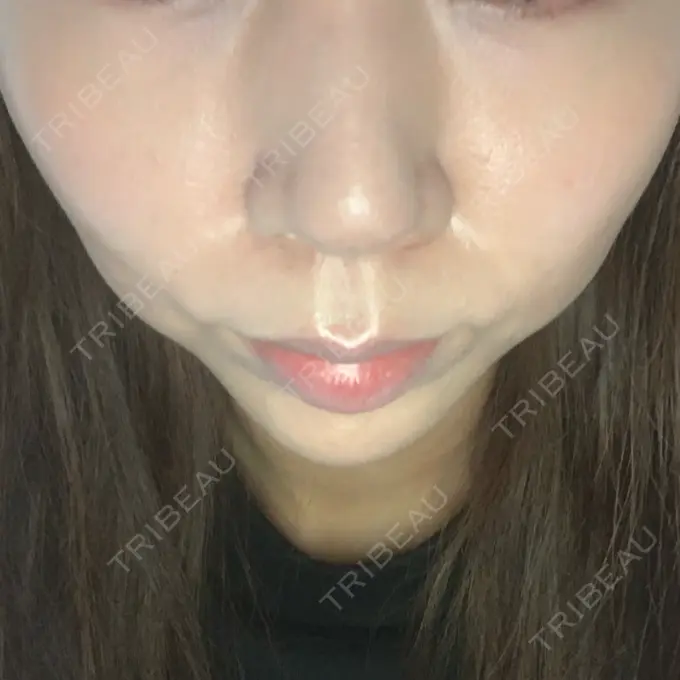 糸リフト MIL CLINIC OSAKA BEFORE メイン用