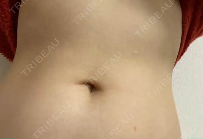 GLP-1ダイエット 湘南美容クリニック 横須賀中央院 BEFORE メイン用