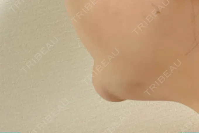 脂肪溶解注射（顔） TCB東京中央美容外科 横浜院 BEFORE メイン用