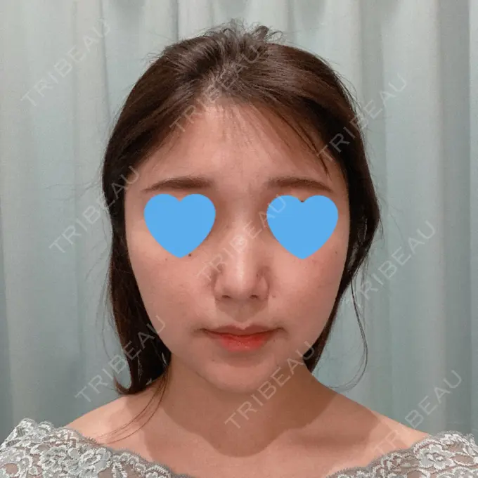 隆鼻術 / 鼻中隔延長（切開） / 軟骨移植 / ワシ鼻修正・ハンプ切除 みずほクリニック BEFORE メイン用