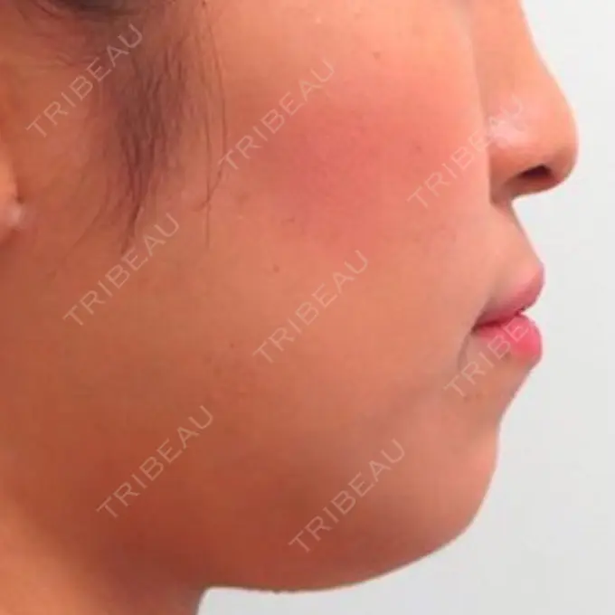 バッカルファット除去 / 脂肪吸引（顔） / セットバック 銀座フェイスクリニック（小顔整形・輪郭整形專門） BEFORE メイン用