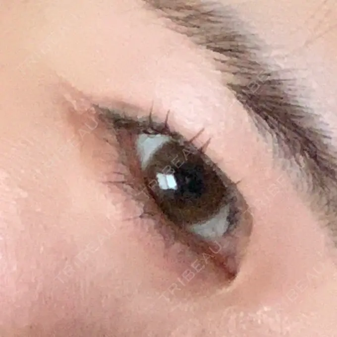 二重埋没 / 目元修正 札幌ル・トロワ ビューティクリニックVogue BEFORE メイン用