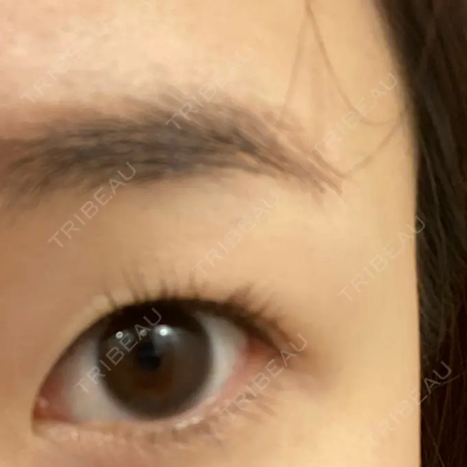 二重埋没 湘南メディカル記念病院（両国） BEFORE メイン用