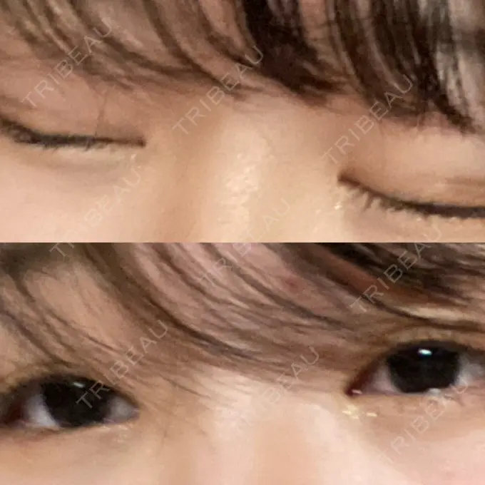 二重埋没 ラミュー広島中央クリニック BEFORE メイン用