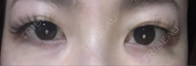 二重埋没 MIL CLINIC OSAKA BEFORE メイン用