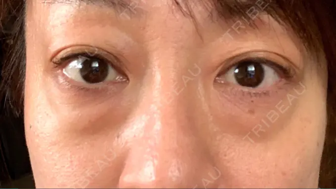 下まぶたたるみ取り / 下まぶたの脂肪取り セオリークリニック BEFORE メイン用