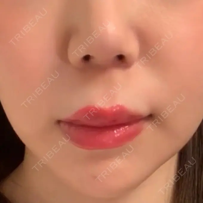 人中短縮 東京皮膚科・形成外科 (銀座いけだクリニック) BEFORE メイン用