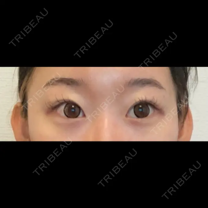 眉下切開 くさのたろうクリニック BEFORE メイン用