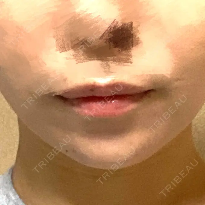 ボトックス（あご） / ヒアルロン酸注入（あご） / ボトックス（エラ・小顔） もとび美容外科クリニック 新宿院 BEFORE メイン用