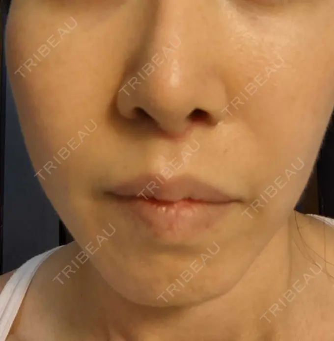 糸リフト / ボトックス（あご） / ヒアルロン酸注入（あご） フローラクリニック BEFORE メイン用