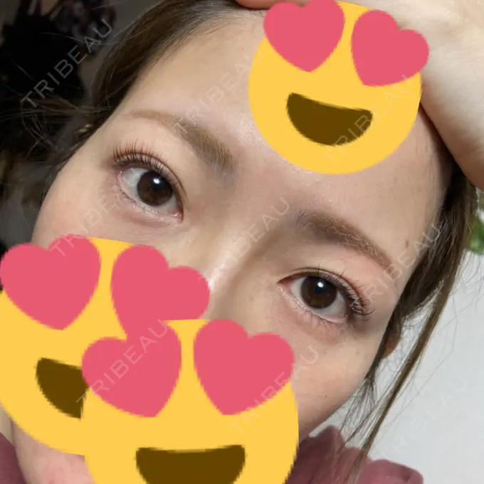 ヒアルロン酸注入（こめかみ） ルラ美容クリニック 渋谷本院 BEFORE メイン用