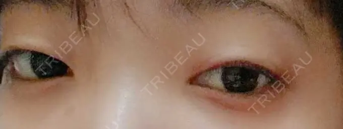 二重埋没 湘南美容クリニック 橋本院 BEFORE メイン用