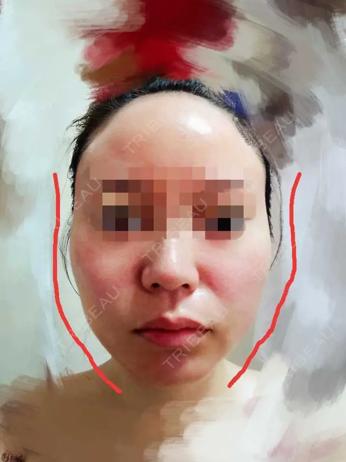 糸リフト TCB東京中央美容外科 八王子院 BEFORE メイン用