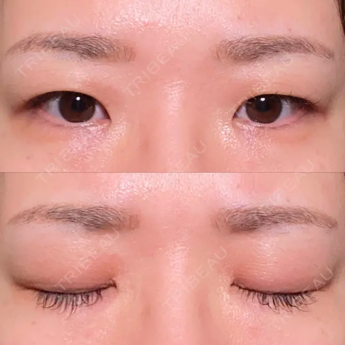 二重埋没 東京BELLEZZAクリニック BEFORE メイン用