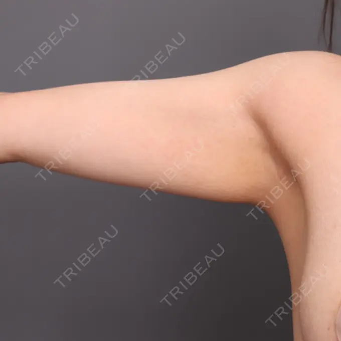 脂肪吸引（二の腕） THE CLINIC（ザ・クリニック） 福岡院 BEFORE メイン用