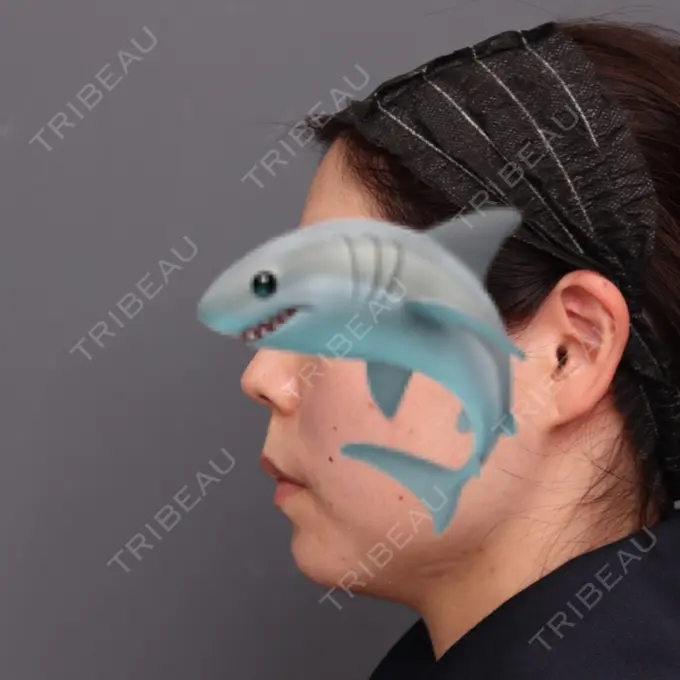 脂肪吸引（顔） THE CLINIC（ザ・クリニック） 福岡院 BEFORE メイン用