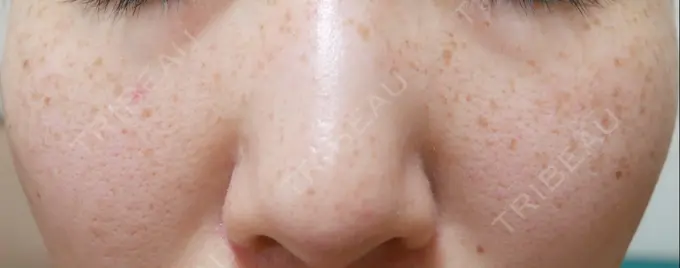 フォトRF 湘南美容クリニック 岡山院 BEFORE メイン用