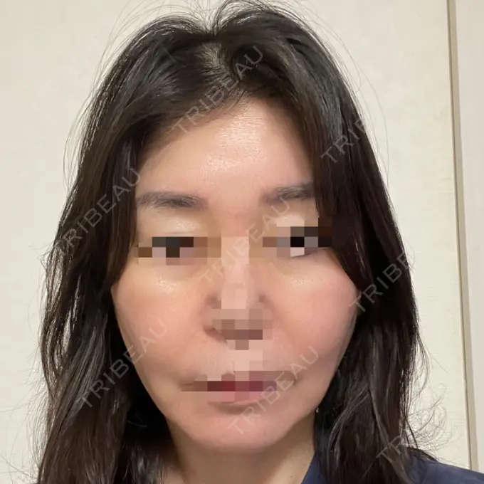 PRP皮膚再生療法 恵聖会クリニック 京橋院 BEFORE メイン用