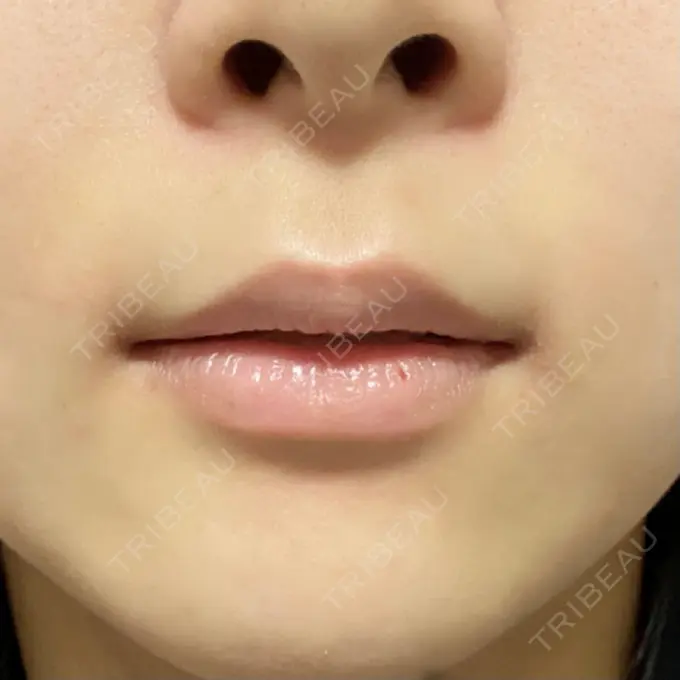 人中短縮 新宿ラクル美容外科クリニック 新宿院 BEFORE メイン用