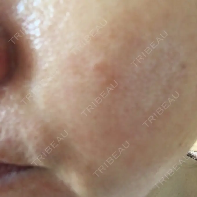 ダーマペン 湘南美容クリニック 武蔵小杉院 BEFORE メイン用