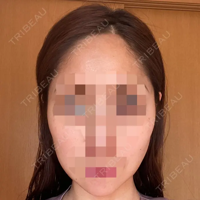 糸リフト / ボトックス（エラ・小顔） TCB東京中央美容外科 立川院 BEFORE メイン用