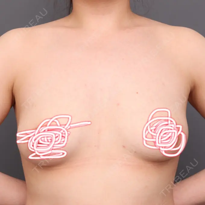 豊胸（脂肪注入） THE CLINIC（ザ・クリニック） 福岡院 BEFORE メイン用