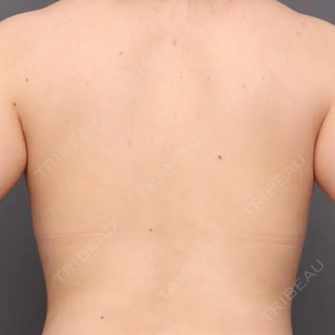 その他（ボディ） THE CLINIC（ザ・クリニック） 福岡院 BEFORE メイン用