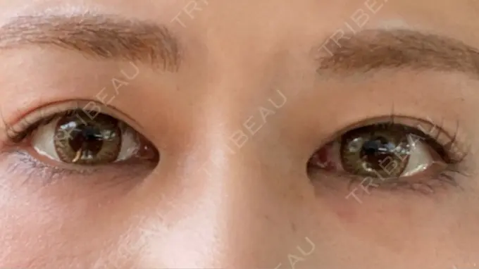 二重埋没 城本クリニック 福岡院 BEFORE メイン用