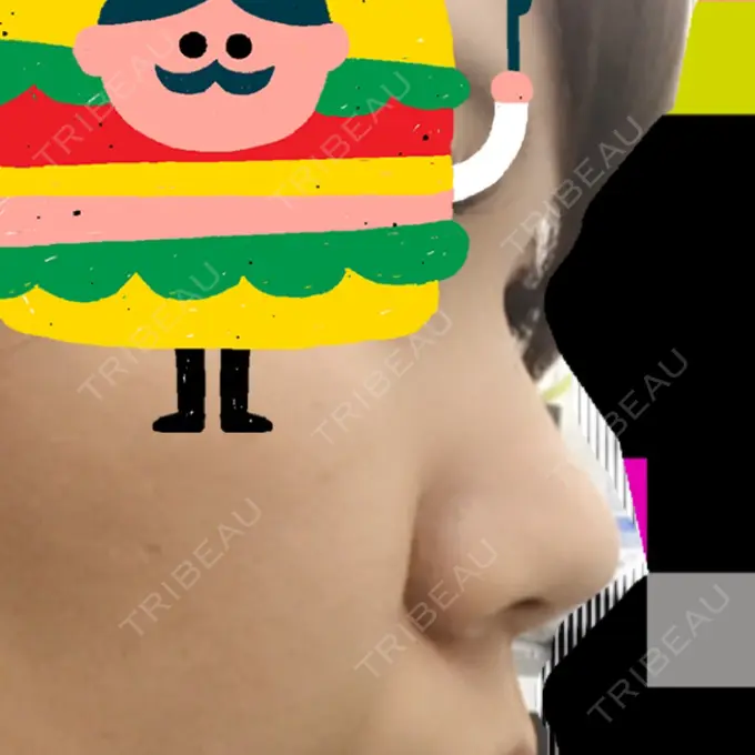 レディエッセ注入（鼻） 赤坂プレミアクリニック BEFORE メイン用