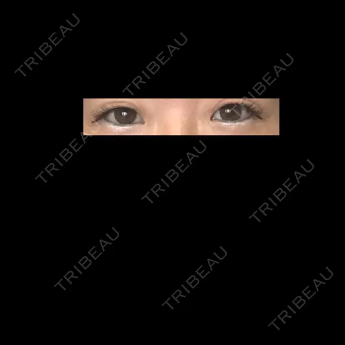 二重埋没 神戸元町ビューティークリニック BEFORE メイン用