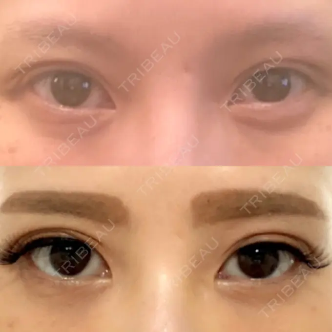 二重埋没 / 目頭切開 湘南メディカル記念病院（両国） BEFORE メイン用