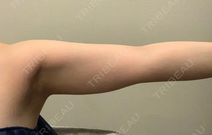 脂肪吸引（二の腕） THE CLINIC（ザ・クリニック） 福岡院 BEFORE メイン用