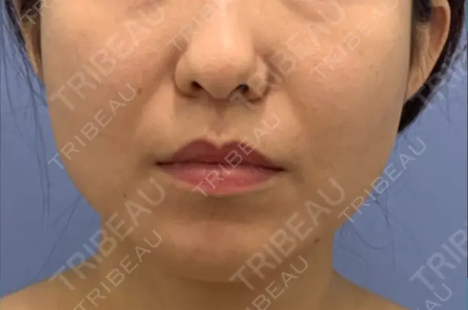 糸リフト / 脂肪吸引（顔） / メーラーファット除去 / ボトックス（エラ・小顔） 湘南美容クリニック 秋葉原院 BEFORE メイン用