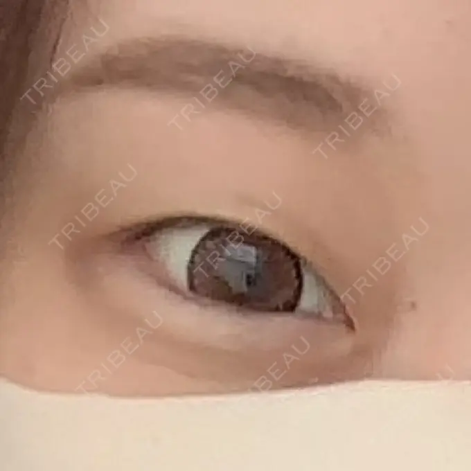 二重埋没 MIL CLINIC OSAKA BEFORE メイン用