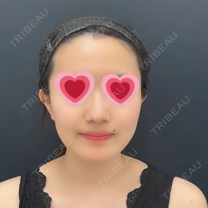 糸リフト / 脂肪吸引（顔） / メーラーファット除去 湘南美容クリニック 秋葉原院 BEFORE メイン用