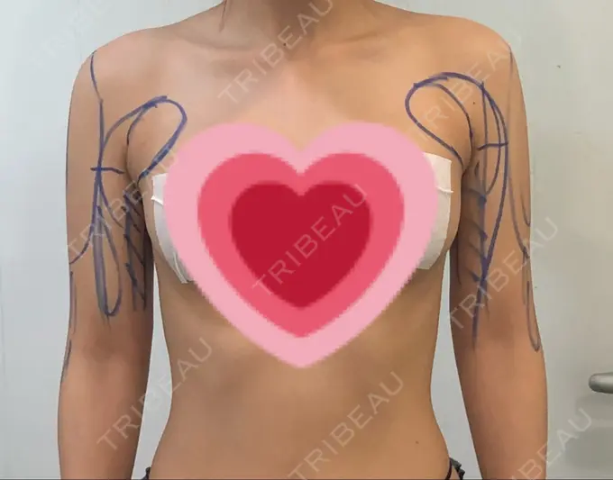 脂肪吸引（二の腕） ヨンセスリムライン BEFORE メイン用