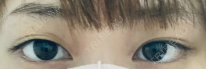 二重埋没 / 目頭切開 湘南メディカル記念病院（両国） BEFORE メイン用