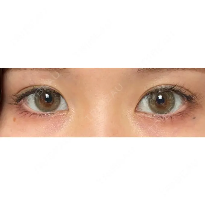 ヒアルロン酸注入（涙袋） Wクリニック 心斎橋院 BEFORE メイン用