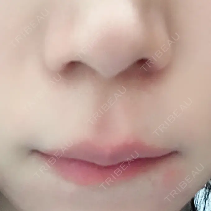 人中短縮 新宿ラクル美容外科クリニック 新宿院 BEFORE メイン用