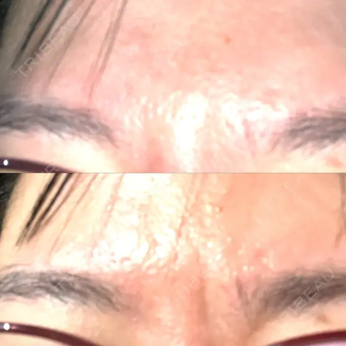 シワ取りボトックス 湘南メディカル記念病院（両国） BEFORE メイン用