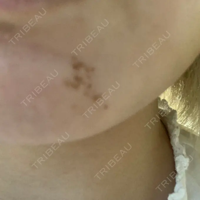 ほくろ・いぼ切除（肌） 新宿新南口れいわクリニック BEFORE メイン用