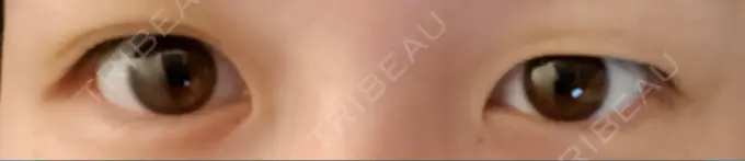 二重埋没 湘南美容クリニック 東京蒲田院 BEFORE メイン用